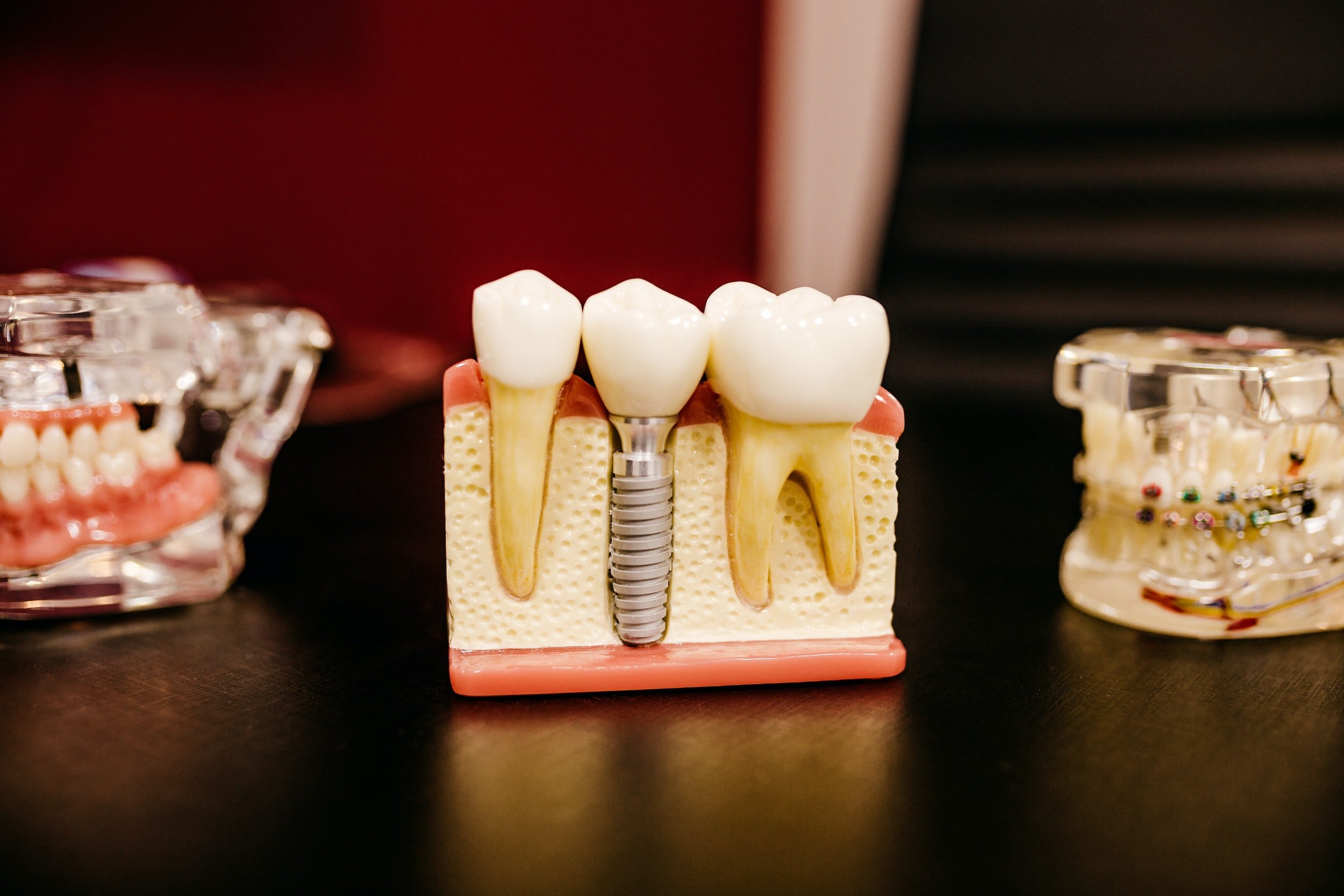Zahnimplantate — Maritima Dental & Esthetics