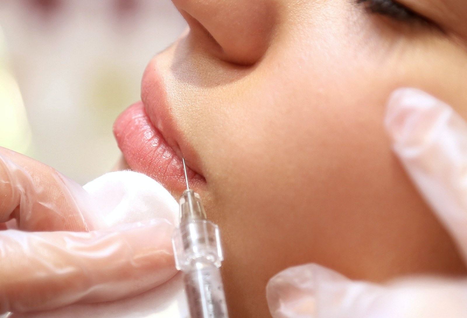 Rellenos Labiales — Maritima Dental & Esthetics Tenerife